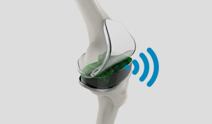 VERASENSETM Sensor-Assisted Total Knee Replacement 