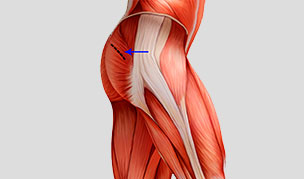 Mini-Posterior Hip Replacement